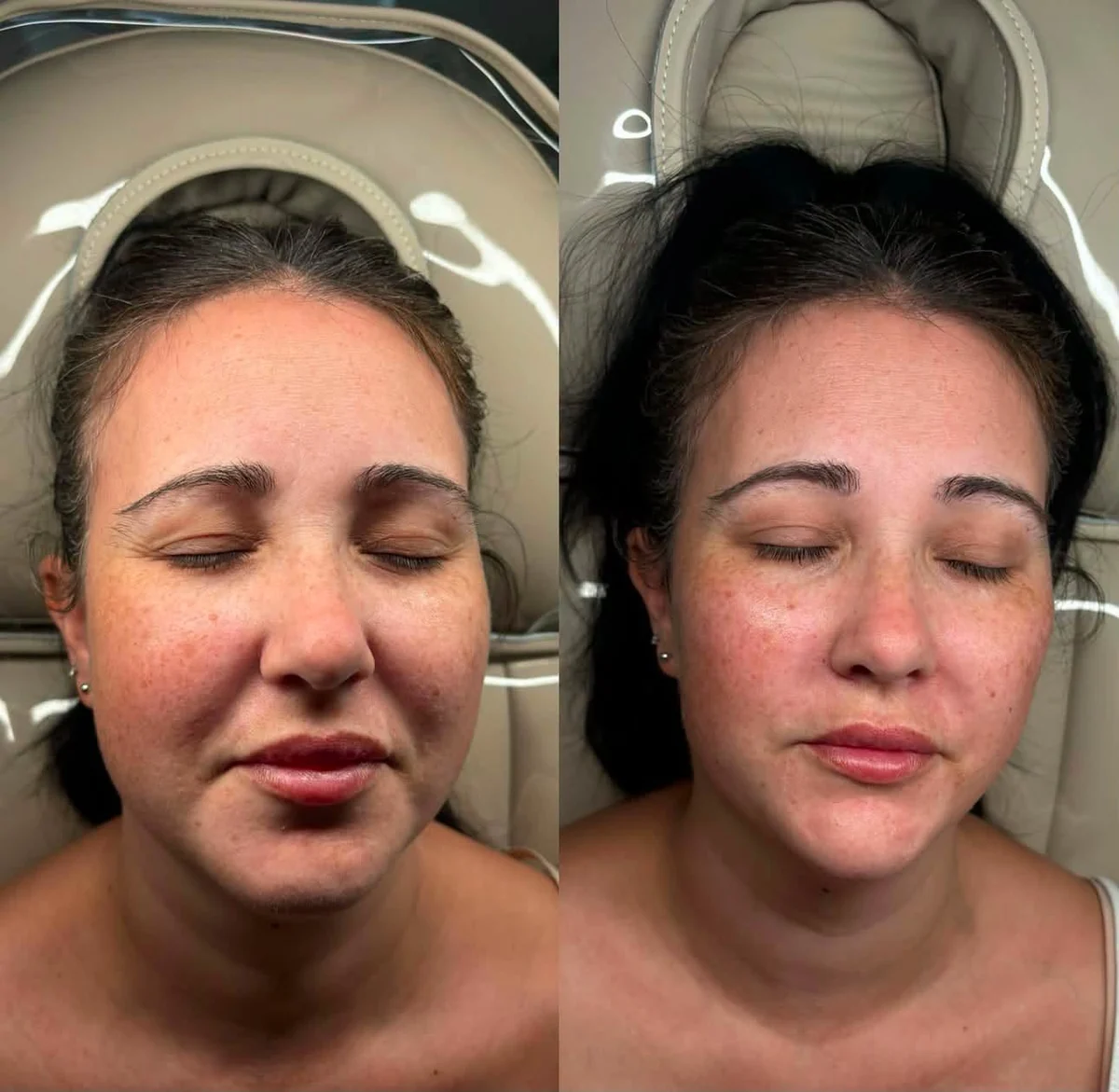 Before and after skin rejuvenation treatment, front view
