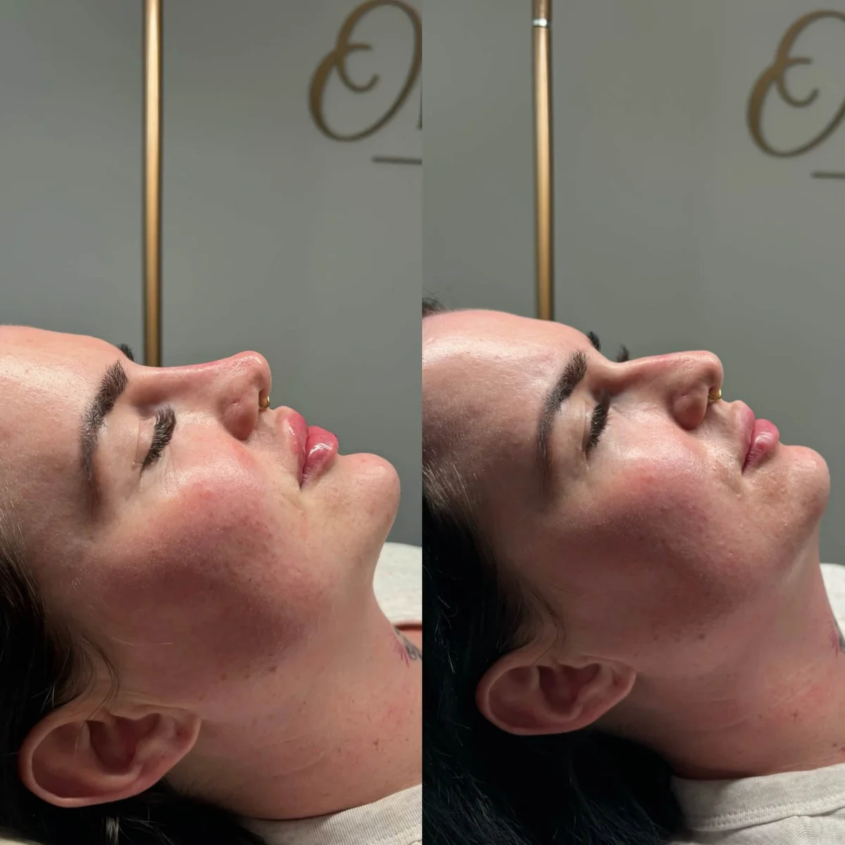 Before and after chin and jawline enhancement, side view